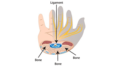 Carpal Tunnel Surgery: More Effective Than Splinting?