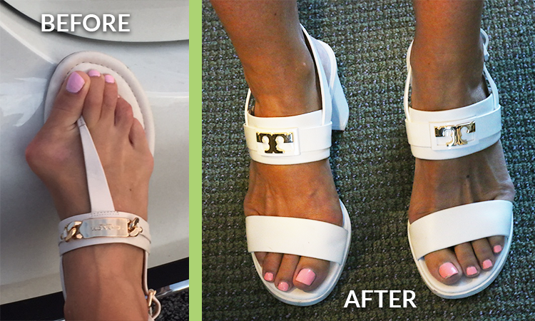 Bunion Removal Surgery Gets Woman Back To The Tennis Court