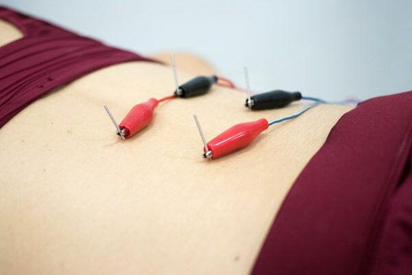 Introducing Dry Needling at South Florida Orthopaedics: Feel Better Faster