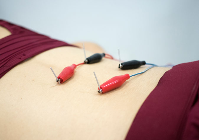 Dry Needling
